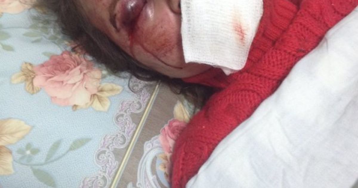 По-звірячому побита журналістка із струсом мозку розповіла про нападників