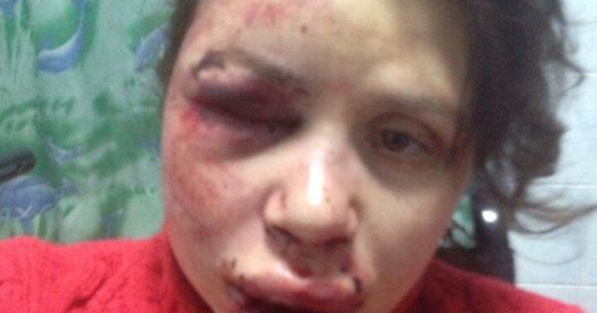 Чорновол жахливо побили і вона потребує операцій