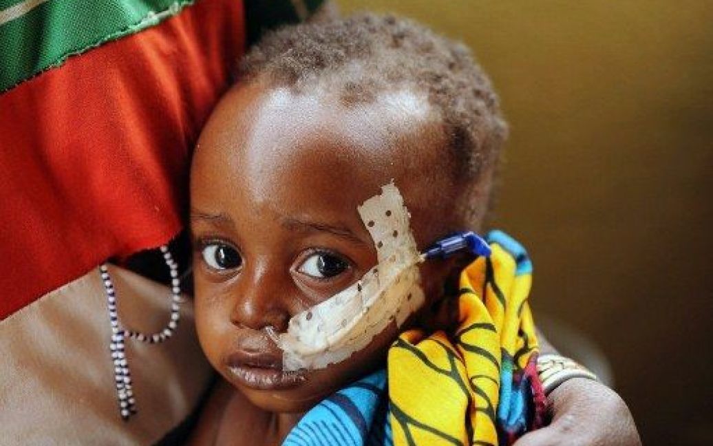 Буркіна-Фасо, Діапага. Дворічний Уобра Компалемба, який страждає від недоїдання і бронхіту, отримує молоко через катетер у лікарні на сході Буркіна-Фасо. / © AFP