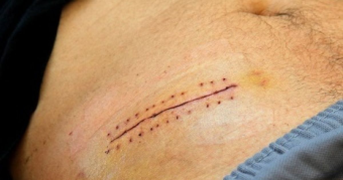 Гострий апендицит запропонували лікувати без операції
