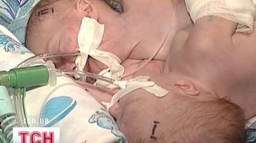 В Краматорске в пять утра умерли сиамские близнецы