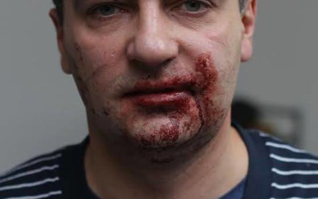 Журналіста Дмитра Гнапа до крові побили невідомі молодики / © ДСНС
