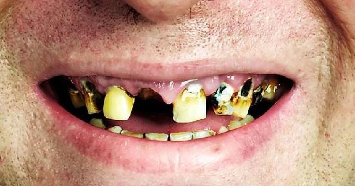 Американець повиривав дружині зуби через сварку за гроші