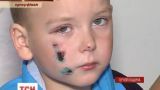 На Тернопільщині петарда ледь не залишила без ока та руки 3-річного хлопчика
