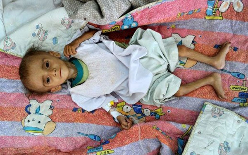 Афганістан, Кабул. Однорічний Мухаммад Юсуф, який страждає від важкої ступені недостатності харчування, отримує лікування у лікарні Ганді в Кабулі. Більше 6% дітей у віці до п&#039;яти років в Афганістані страждають від гострого недоїдання. / © AFP
