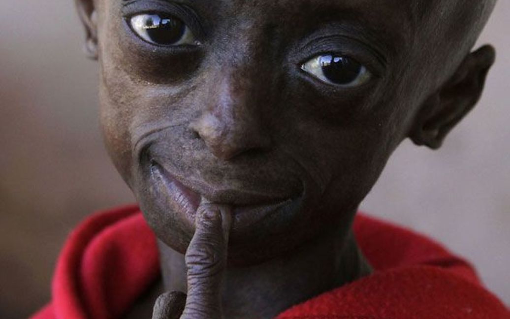 У південноафриканському місті Хеврон живе 12-річна Онтламетсе Фаласте, яка є єдиною в світі темношкірою дитиною, що страждає на синдром Гетчінсона-Гілфорда. / © bigpicture.ru