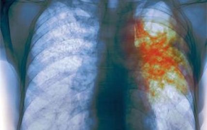 Україна стала 7-ю у Європі за рівнем захворюваності на туберкульоз