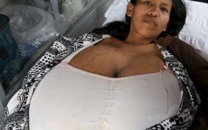 Жінка зменшила груди на 16 кілограмів