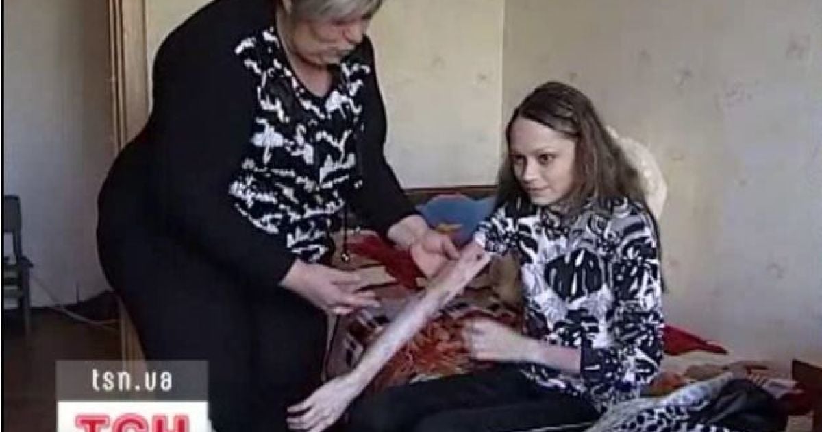 У Елены остались лишь 2 процента не пораженной болезнью кожи