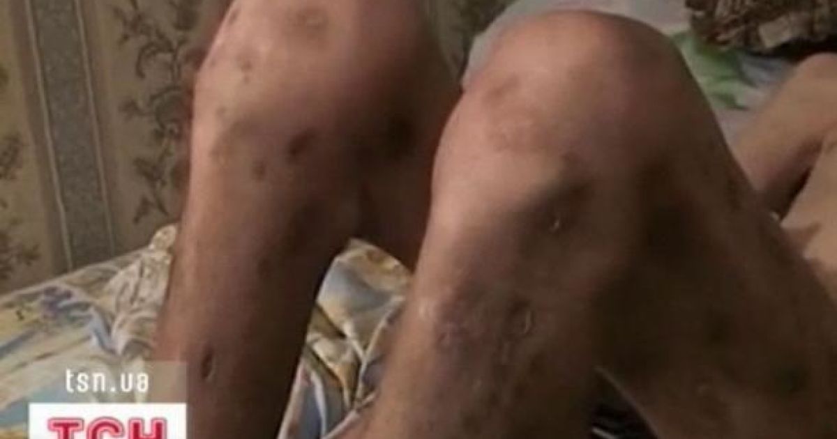 "Крокодил" відгризає наркоманам кінцівки за два роки