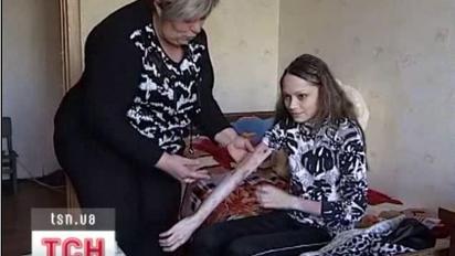 У Дніпропетровській області живе дівчина майже без шкіри