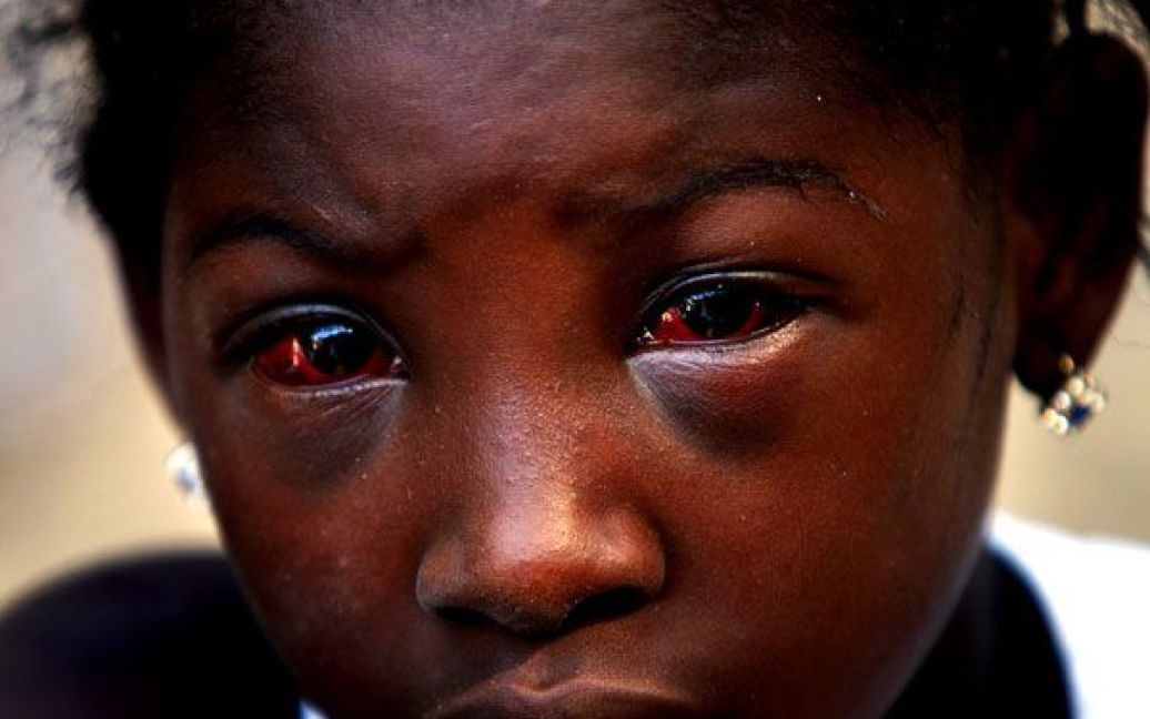 Восьмирічна Дафкалія Брігнол отримала травму голови, коли на неї впали двері, під час землетрусу на Гаїті у січні 2010 року. (Rick Loomis/Los Angeles Times) / © Los Angeles Times
