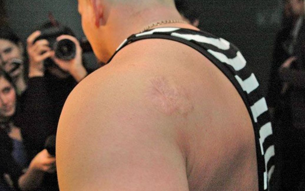 Плече Вірастюка прикрашає ось такий шрам. / © ТСН.ua