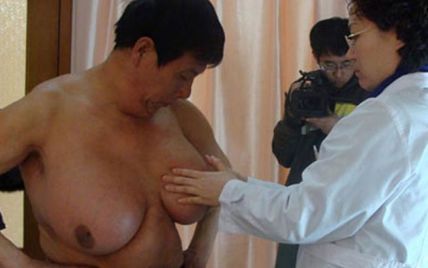 У китайського чоловіка виросли жіночі груди 6 розміру