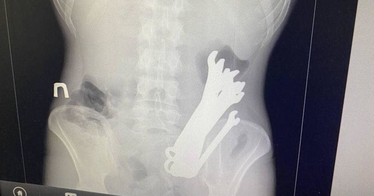 Чоловік проковтнув шість гайкових ключів / Фото: Відділення торакальної хірургії