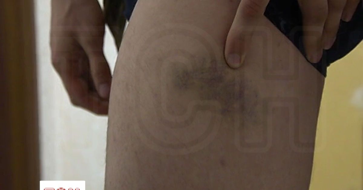 Краснов показал синяки на теле и не узнал голоса на записи – эксклюзив ТСН