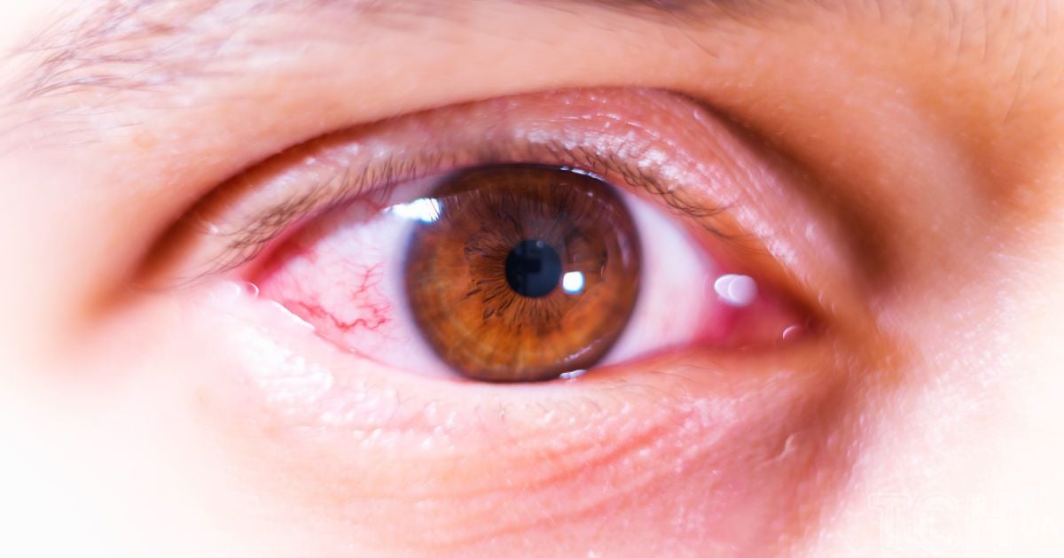 Чому не варто терти очі