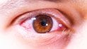Почему не стоит тереть глаза