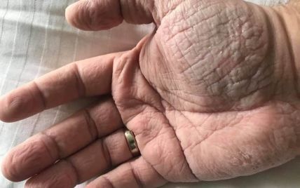 "Злість і відчай": лікар показав свої руки після роботи з хворими на COVID-19