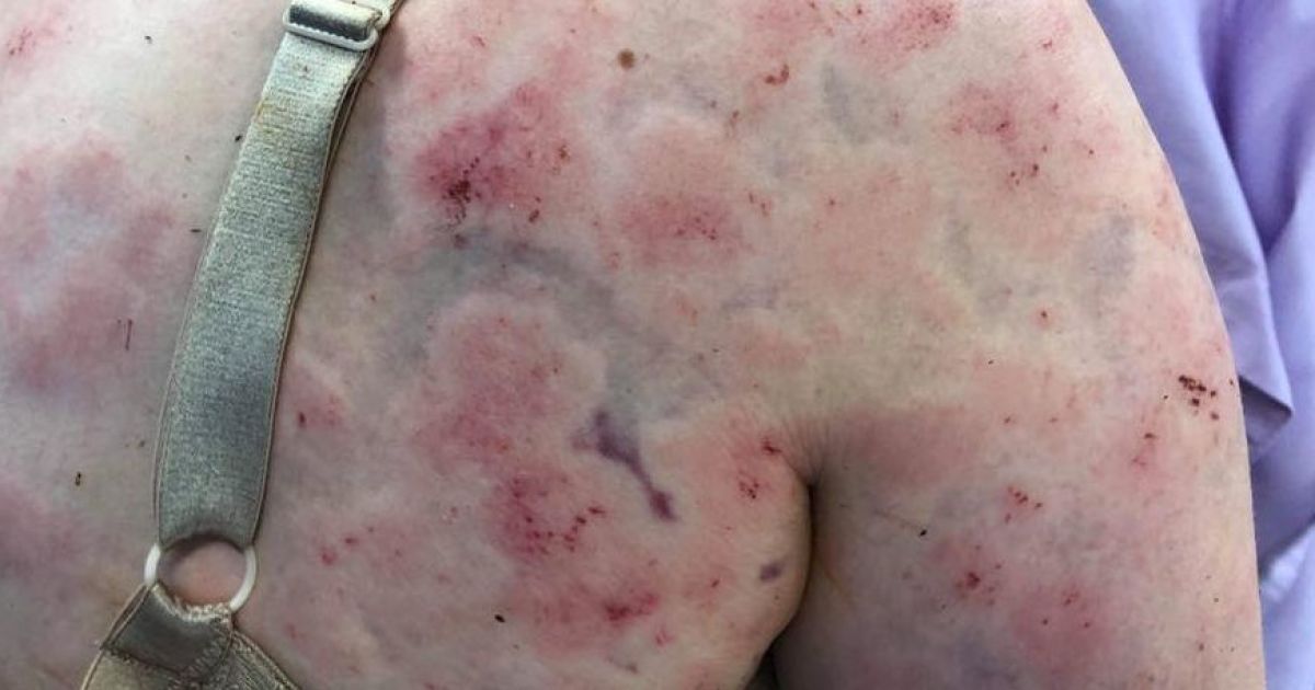 Ховала від ударів дитя. Героїчна авcтралійка показала понівечене страшенним градом тіло й обличчя