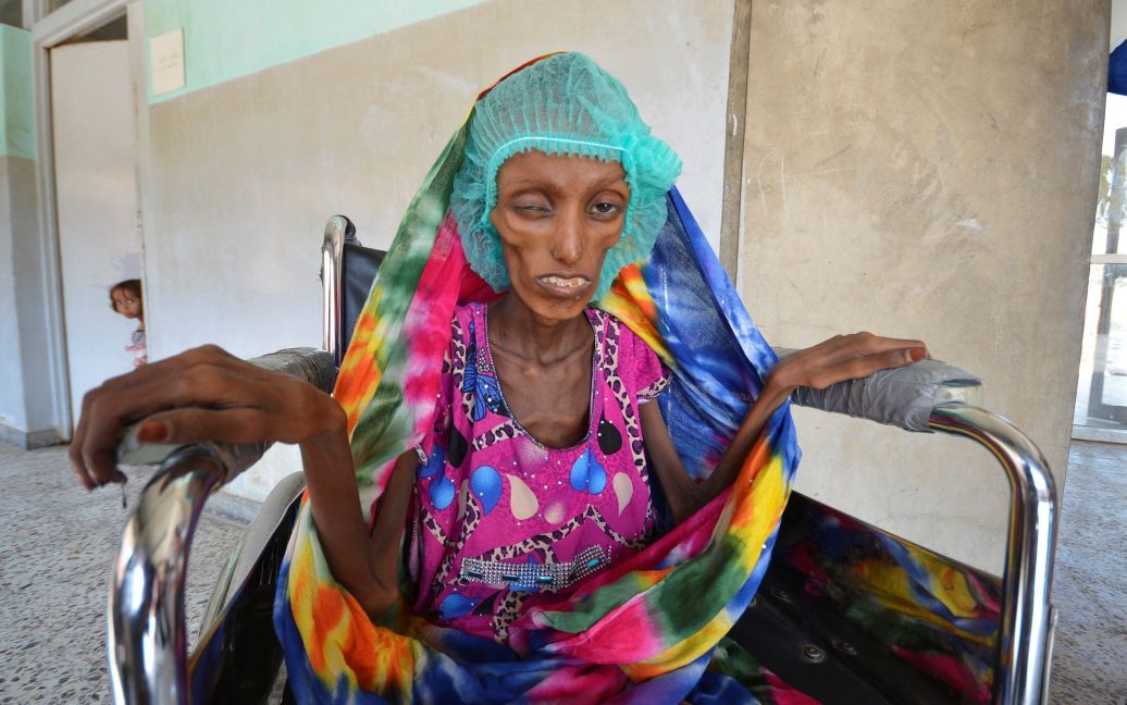 18-летняя Саида Ахмад Багхілі сидит в инвалидной коляске в больнице Аль-Тавра, где она получает лечение от тяжелой острой недостаточности питания в городе Ходейда, Йемен. / © Reuters