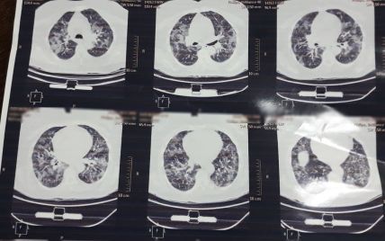 "Найстрашніші легені, які я коли-небудь бачила": у соцмережі показали легені тяжкохворого пацієнта з коронавірусом (фото)