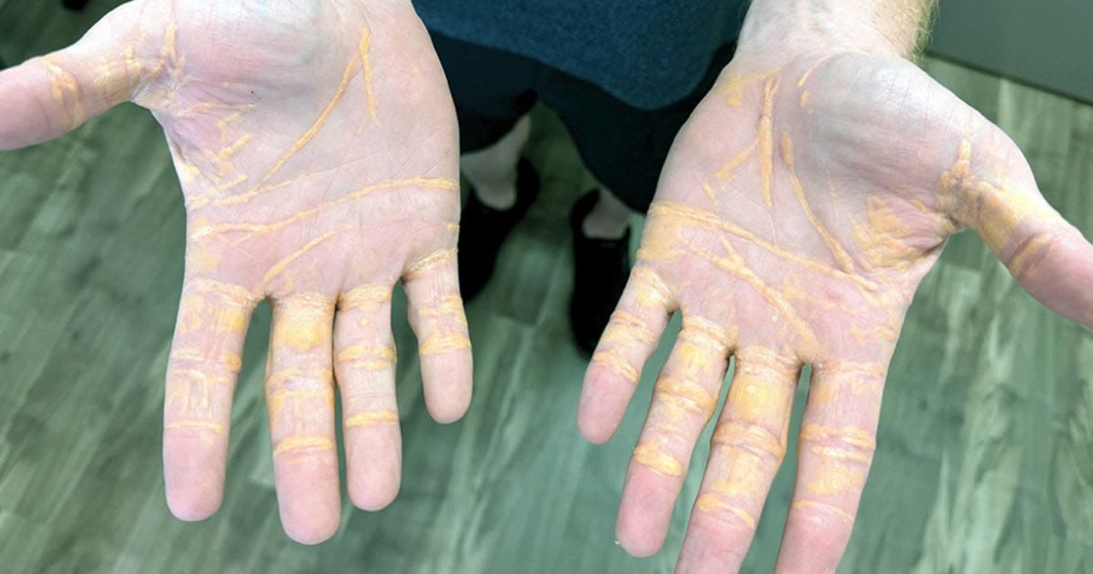 Відкладення холестерину під шкірою зблизька. Marmagkiolis et al. / JAMA Cardiology, 2025