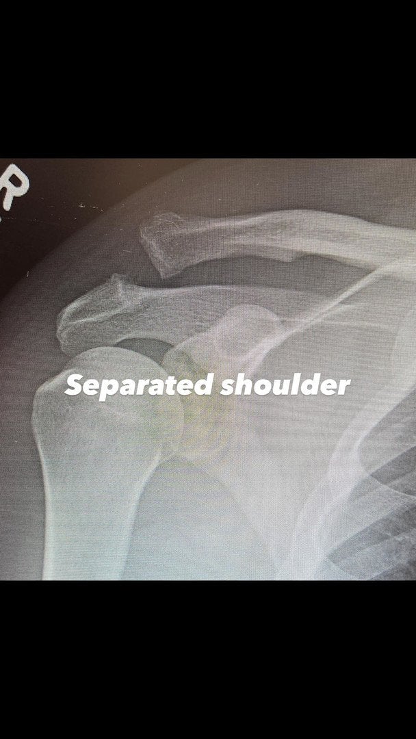 Плече Ченнінга Татума до операції / © instagram.com/channingtatum