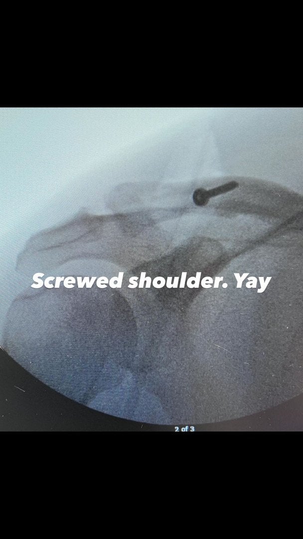 Плече Ченнінга Татума після операції / © instagram.com/channingtatum