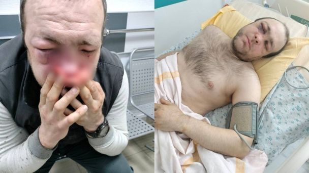 Орест Паньків після побиття чоловіком у військовій формі / © Суспільне
