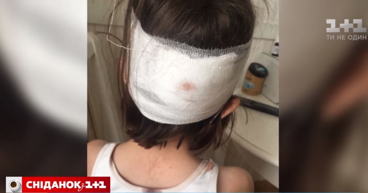 Скандал у столичній школі: дитині з розбитою головою не викликали швидку