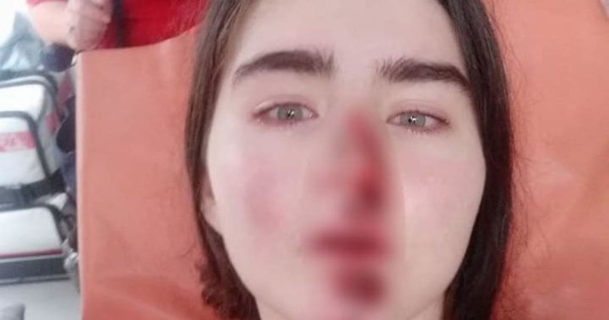 Прыгала на ходу, чтобы не попасть под машину: в Киеве девушка разбила лицо и руки из-за неисправного арендованного самоката