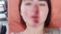 Прыгала на ходу, чтобы не попасть под машину: в Киеве девушка разбила лицо и руки из-за неисправного арендованного самоката