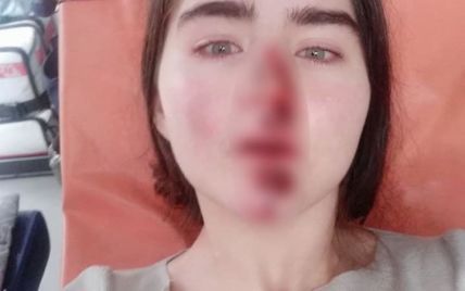 Стрибала на ходу, щоб не втрапити під машину: у Києві дівчина розбила обличчя та руки через несправний орендований самокат