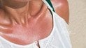 Лето и кожа: 12 распространенных проблем и как их избежать