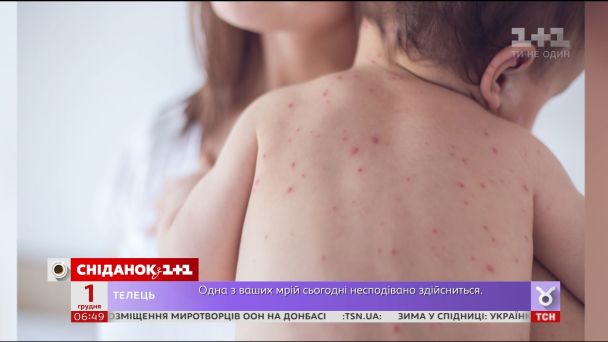 В Украине стремительно растет заболеваемость корью: уже зафиксированы смертельные случаи
