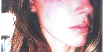 Новые синяки на лице Эмбер Херд: актриса продолжает обвинять Джонни Деппа в насилии