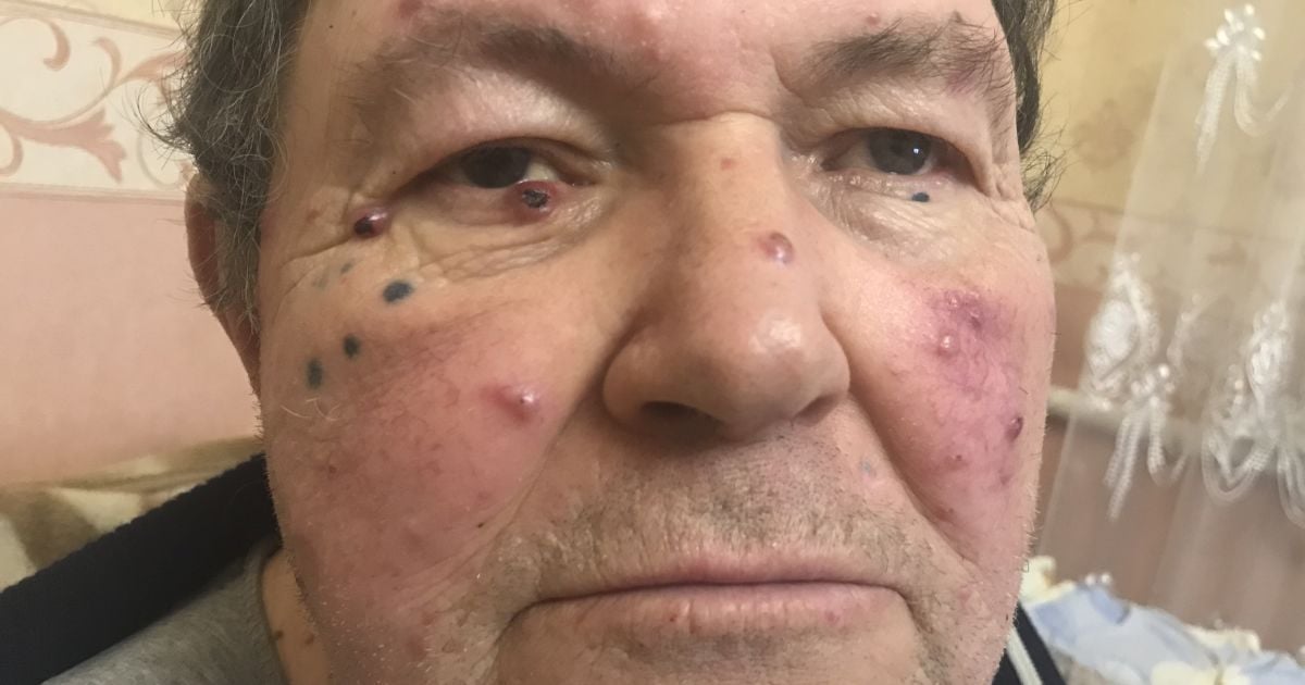 Негайної допомоги потребує Віктор, щоб позбутись раку шкіри
