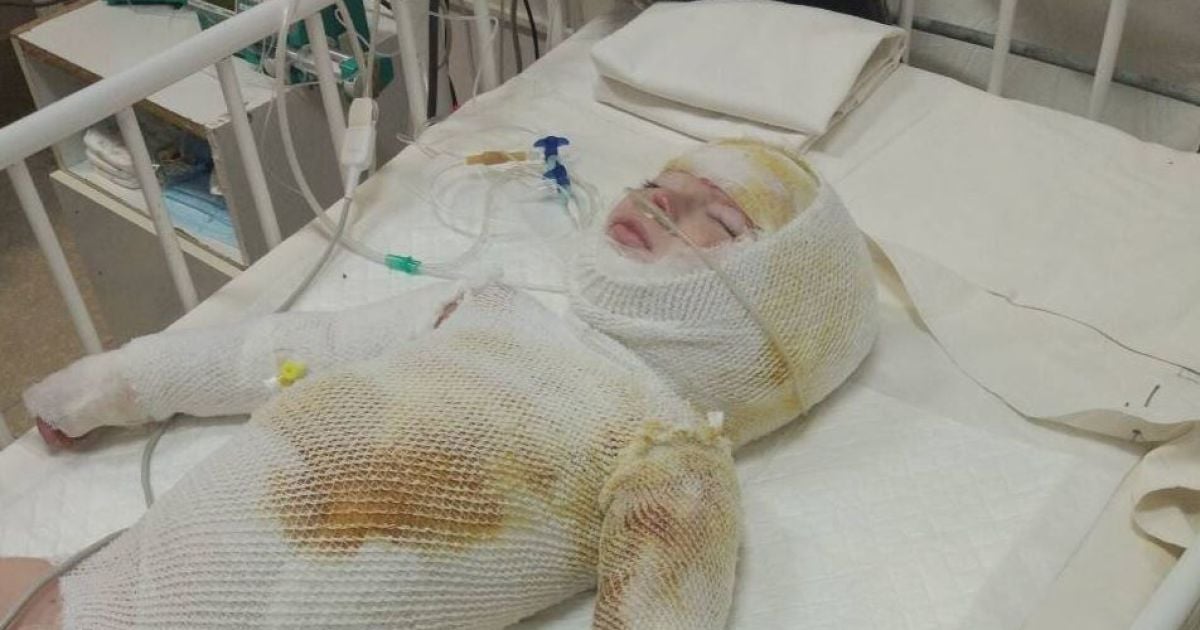 Зрители ТСН помогли собрать достаточно средств на лечение обожженного Ярославчика