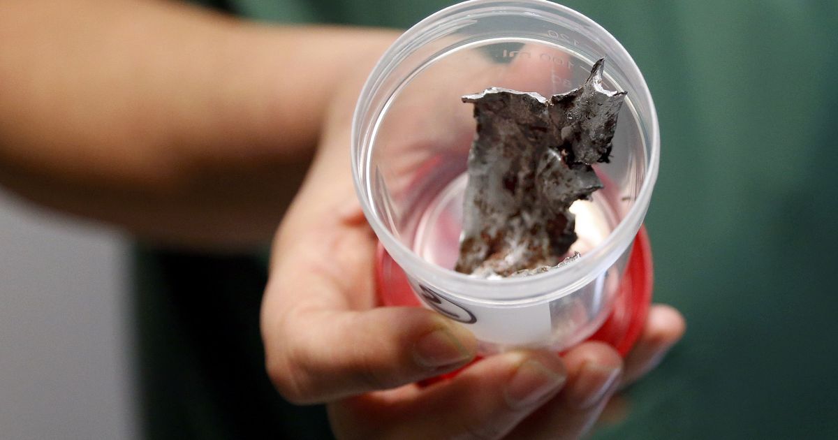 Врачи показали щматки шраплені, которые извлекли из тел раненых. / © Reuters