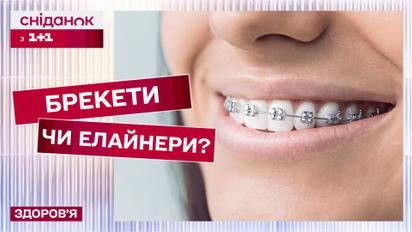 Брекети vs елайнери! Переваги та недоліки – Здорова усмішка