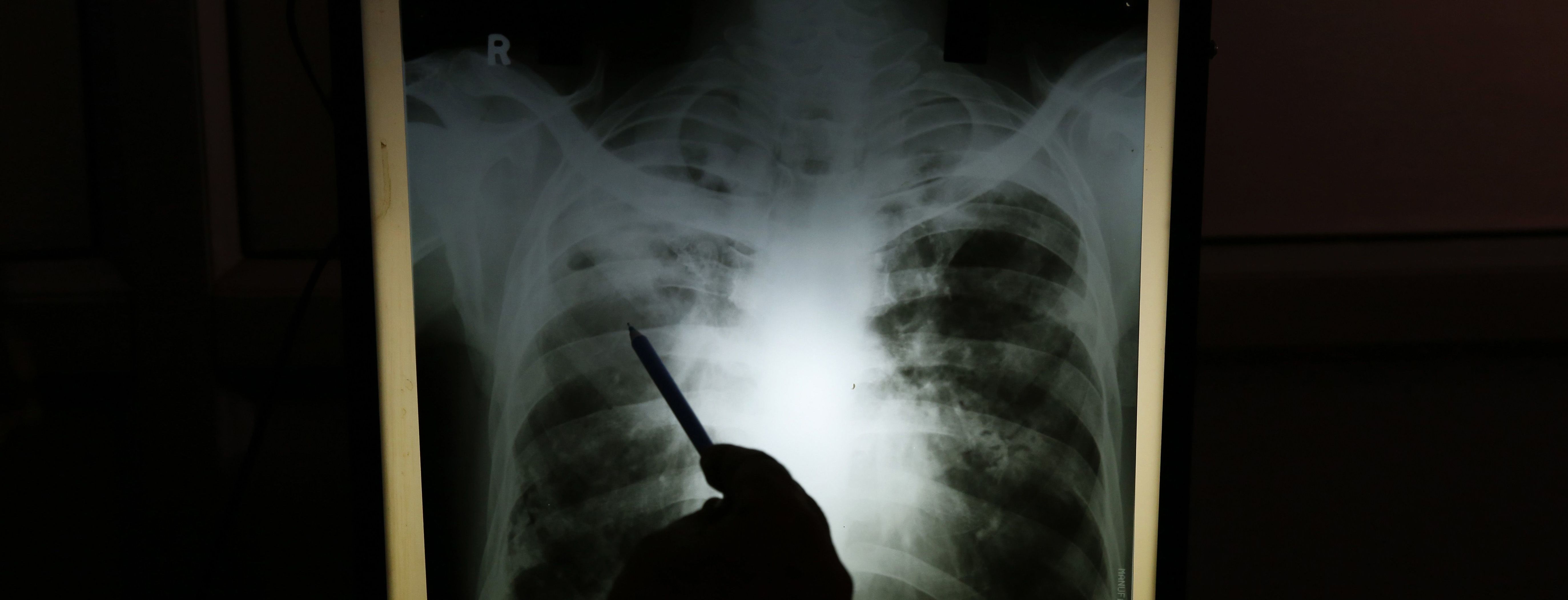 Почти 1200 случаев туберкулеза зарегистрировано в Украине в августе: кто болеет