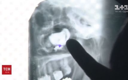 Медики Кривого Рогу запевняють, що їхній пацієнт вигадав забутий на три роки бинт у носі