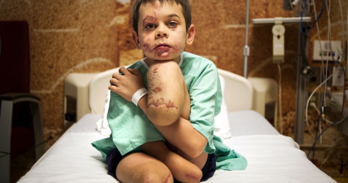 Первое место в номинации Portrait and Personality. Коля Нижниковский из поселка Володарское во время лечения в одной из клиник в Монреале. Вместе с братом он подорвался на гранате на Донбассе и остался без обеих ног. Фото Марты Иванек