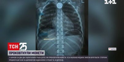 У Харкові за два дні ушпиталили трьох дітей, які проковтнули монети | Новини України