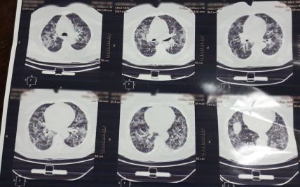 Який вигляд мають легені хворого з коронавірусом після антибіотиків: лікар показав моторошне фото